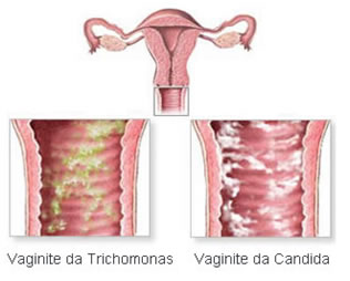 Sintomi vaginite
