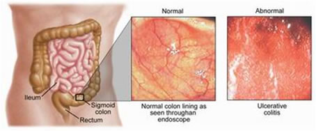 Diagnosi Colite Ulcerosa