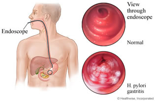 Diagnosi gastrite