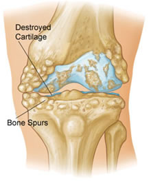 Artrosi al ginocchio Osteofiti
