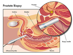 biopsia prostatica