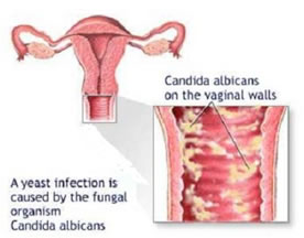 Candida vaginale