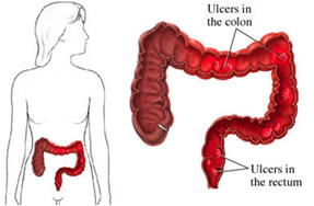 Colite ulcerosa