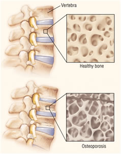 osteoporosi colonna vertebrale