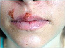 sintomi herpes labbra