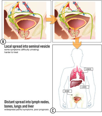 sintomi tumore alla prostata